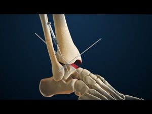How to bill and code Ankle Fusion